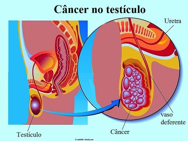 Como fazer o autoexame testicular (em 3 passos) - Tua Saúde